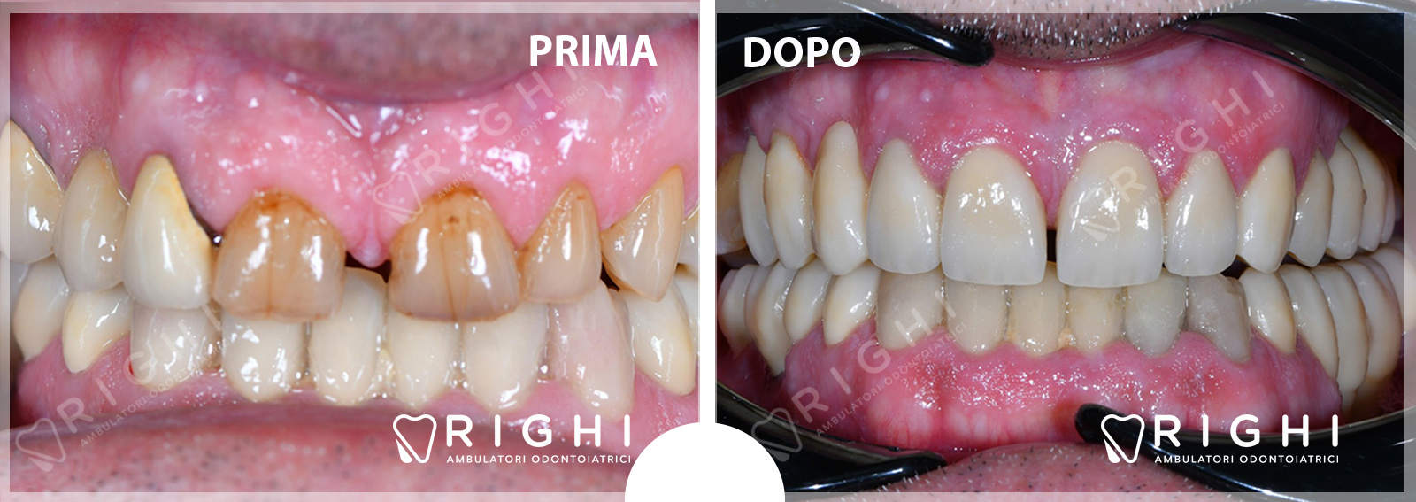faccette dentali estetiche parma e rivalta