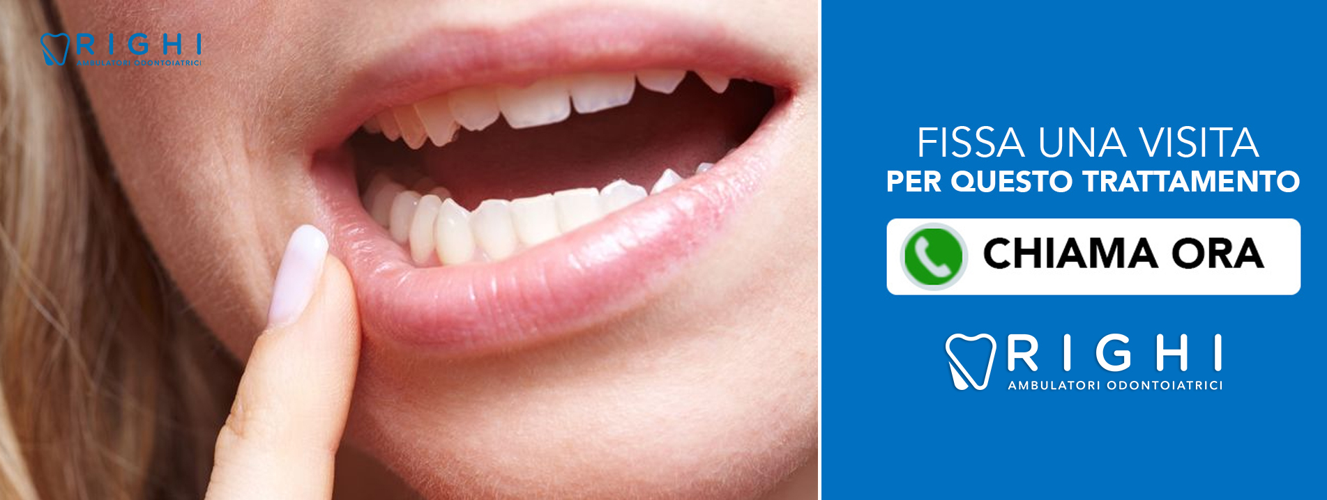 Trattamento-Afte-della-bocca-dentista-Rivalta (Reggio Emilia)