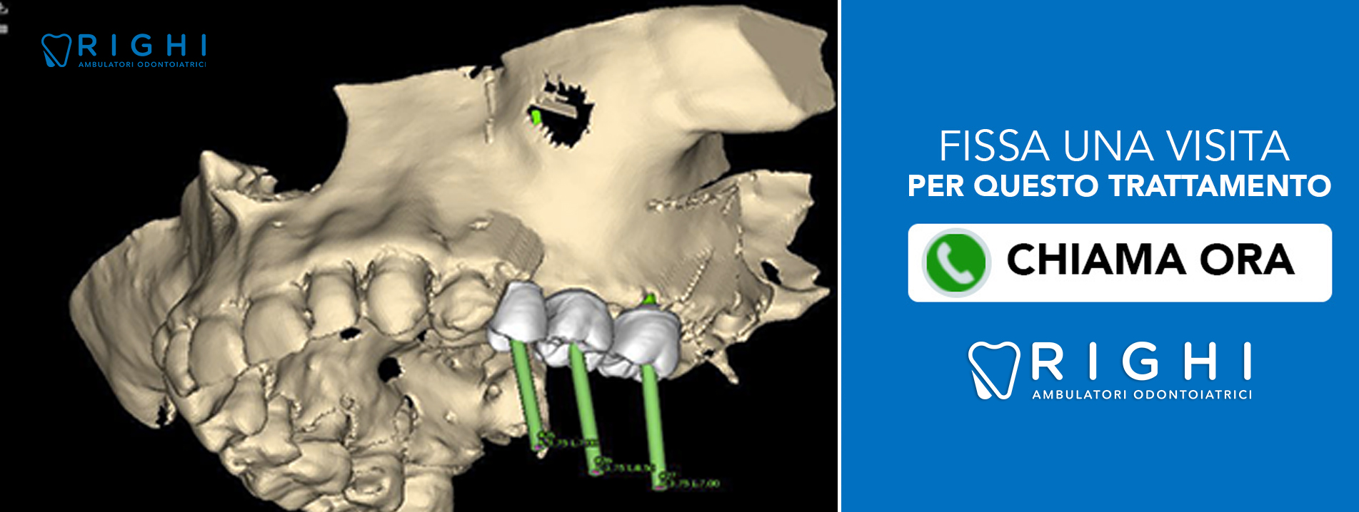 chirurgia-guidata-dentista-Rivalta (Reggio Emilia)