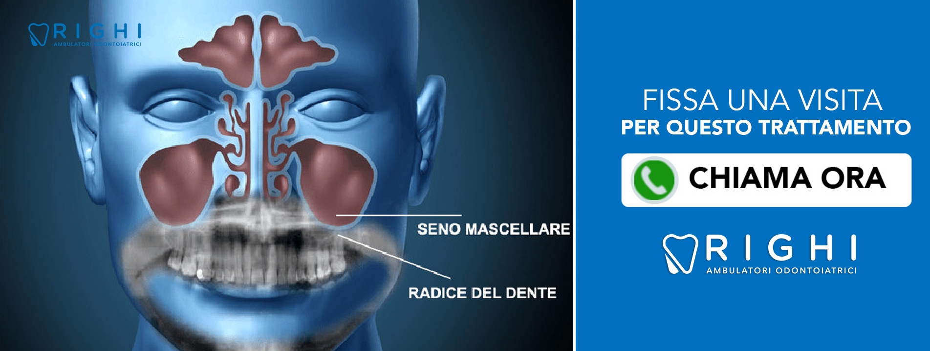 Rialzo seno mascellare-dentista-Rivalta (Reggio Emilia)