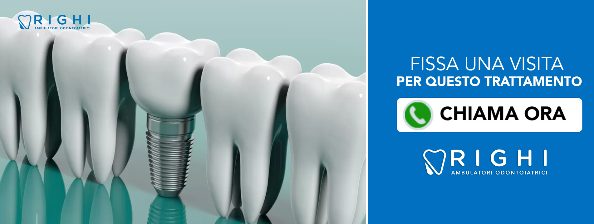 implantologia-carico-immediato-dentista-Rivalta (Reggio Emilia)