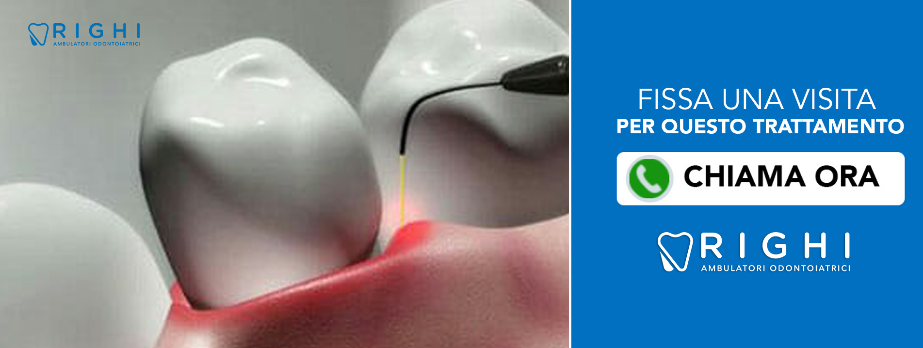 recessioni-gengivali-dentista-Rivalta (Reggio Emilia)